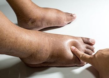 The feet of people with diabetes, dull and swollen. Due to the toxicity of diabetes placed on a white background. Fingers hit the back of the diabetic foot. To test foot swelling.